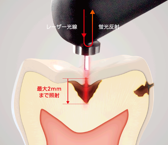 ダイアグノデントペン